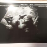 妊婦健診 妊娠37週